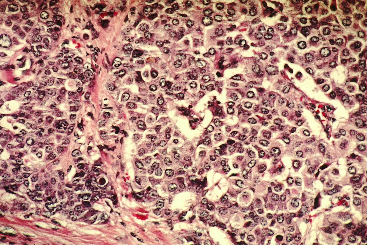 H and E stained breast cancer cells growing into surrounding tissue