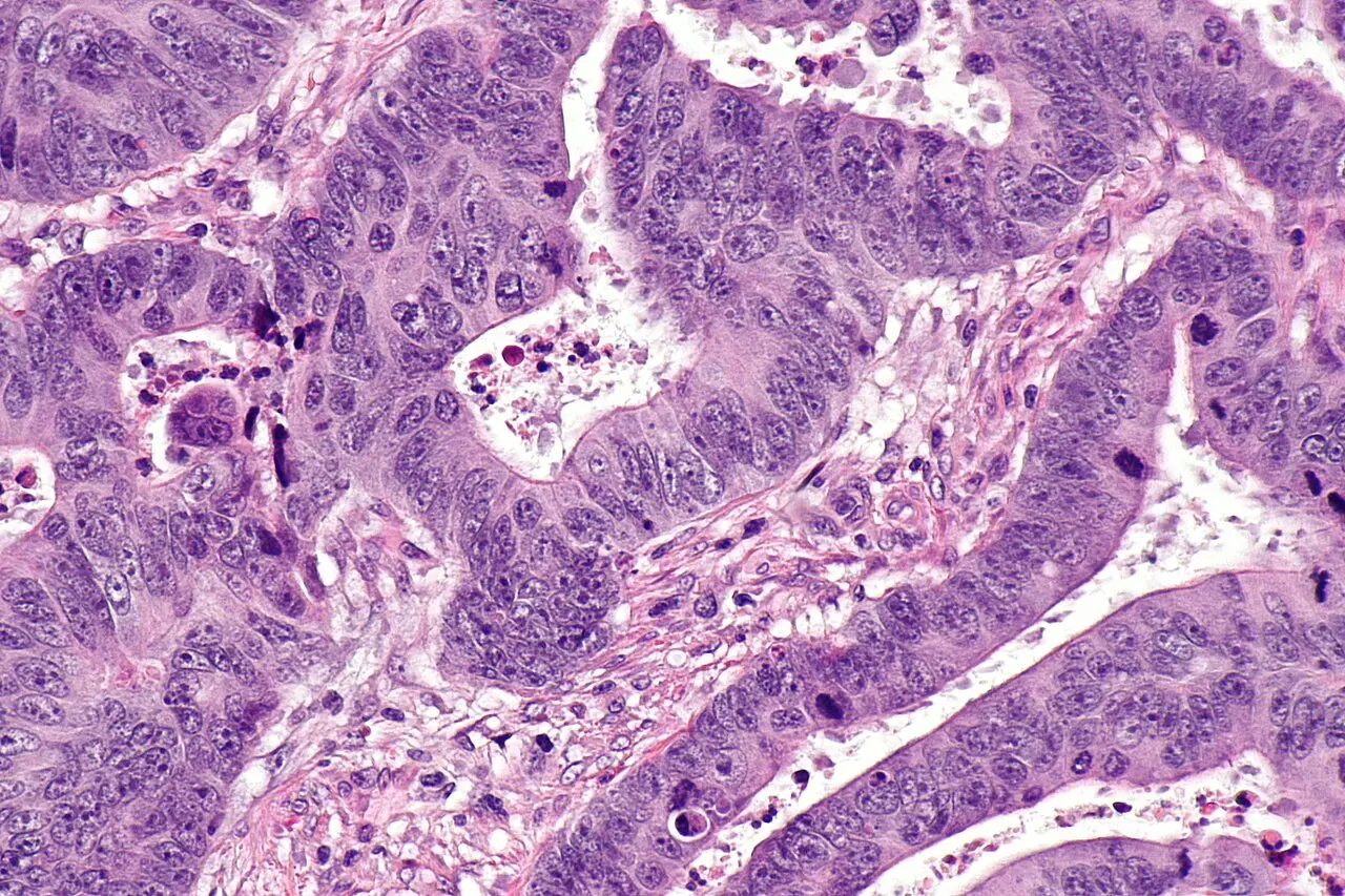 H and E stained colorectal adenocarcinoma at high magnification