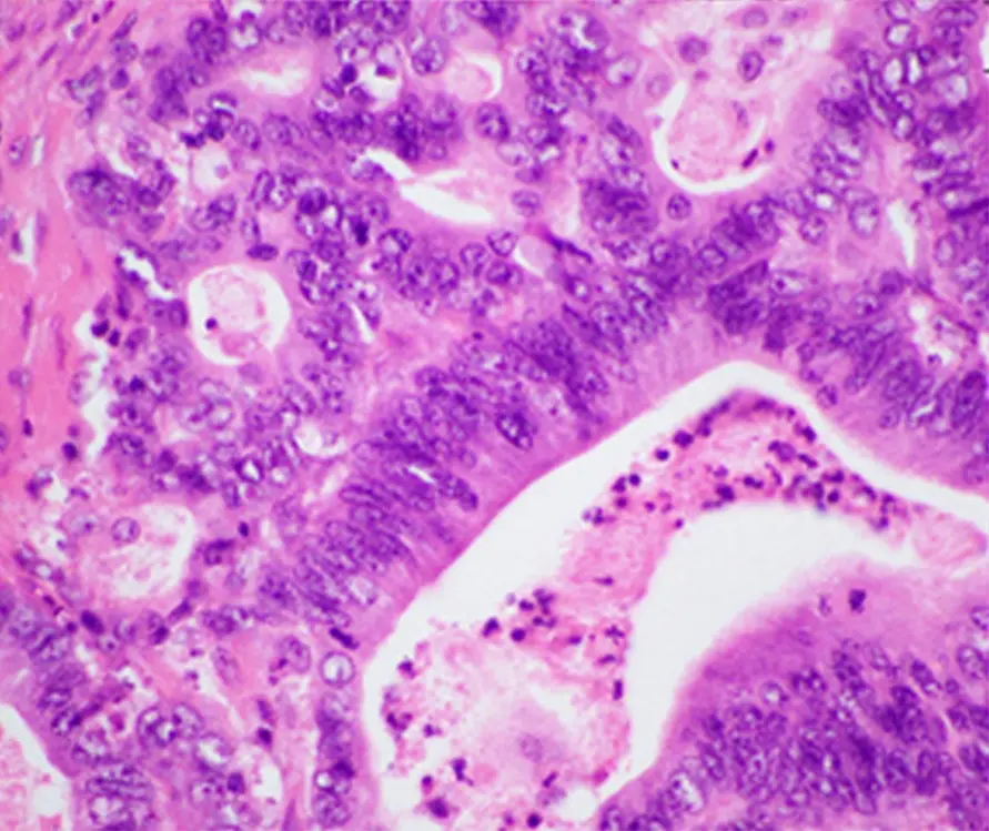 H and E stained histopathology image of pancreatic ductal adenocarcinoma