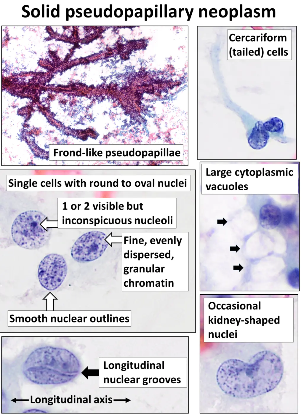 Labeled cytology panel showing a solid pseudopapillary neoplasm of the pancreas