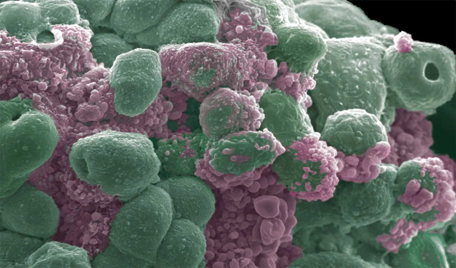 Colorized electron microscopy image of prostate cancer cells treated with nanosized drug carriers