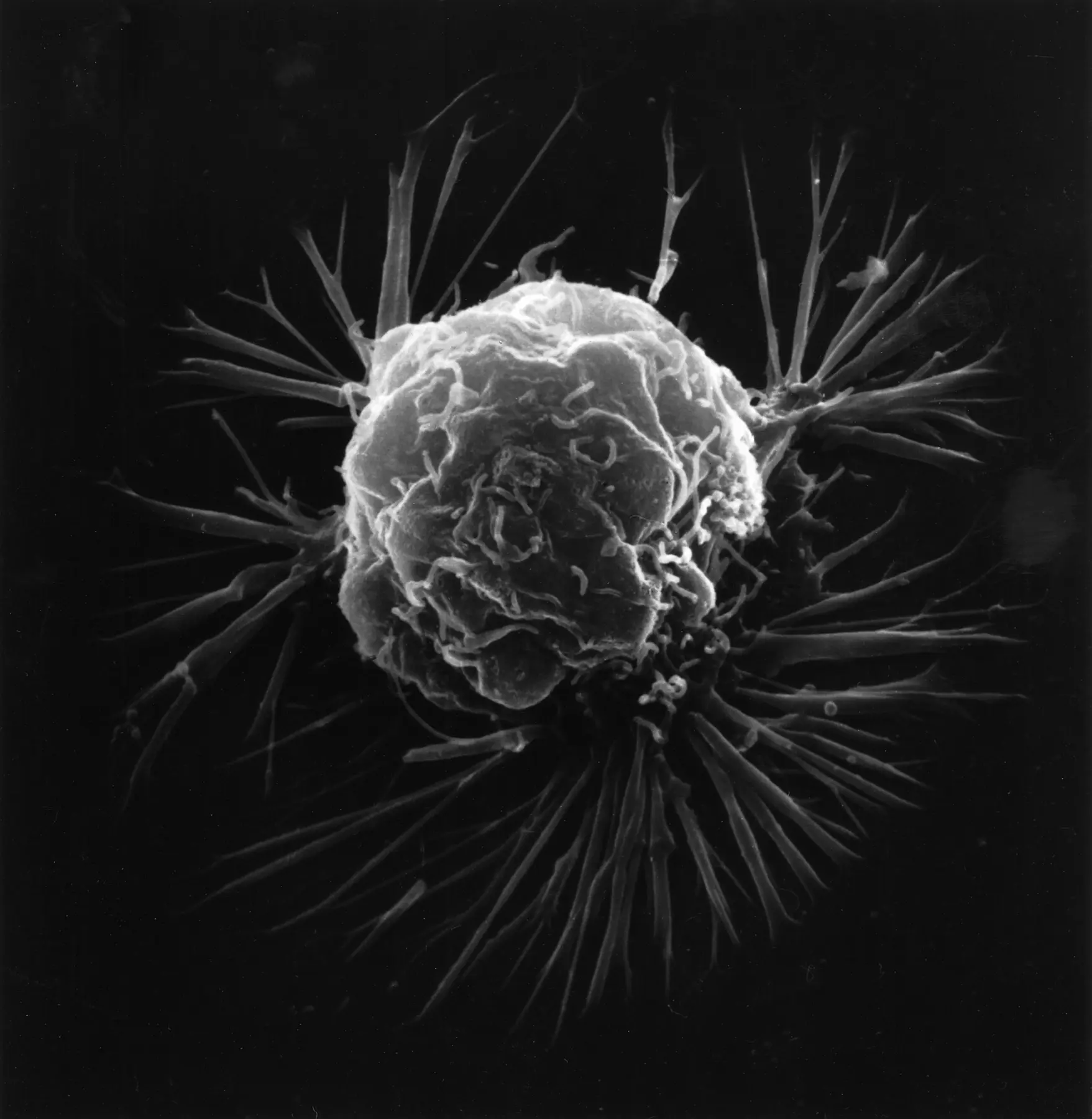 Scanning electron micrograph of a breast cancer cell
